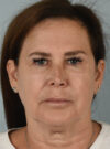 Eyelid Surgery case #11407