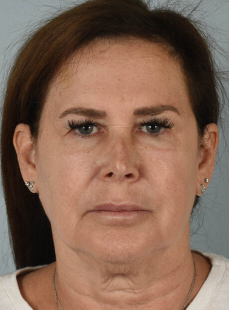 Eyelid Surgery case #11407