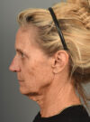 Facelift case #11546