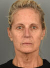 Facelift case #11546