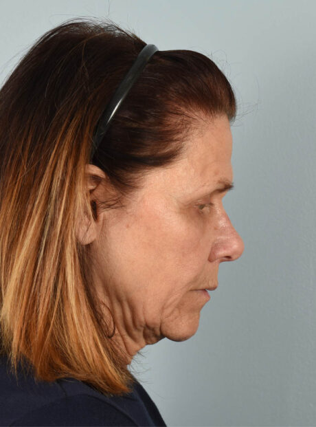 Facelift case #11430