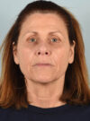 Facelift case #11430