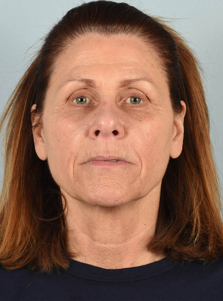 Facelift case #11430