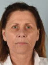 Facelift case #11430