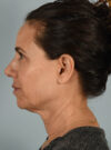 Facelift case #11574