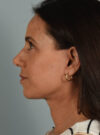 Facelift case #11574