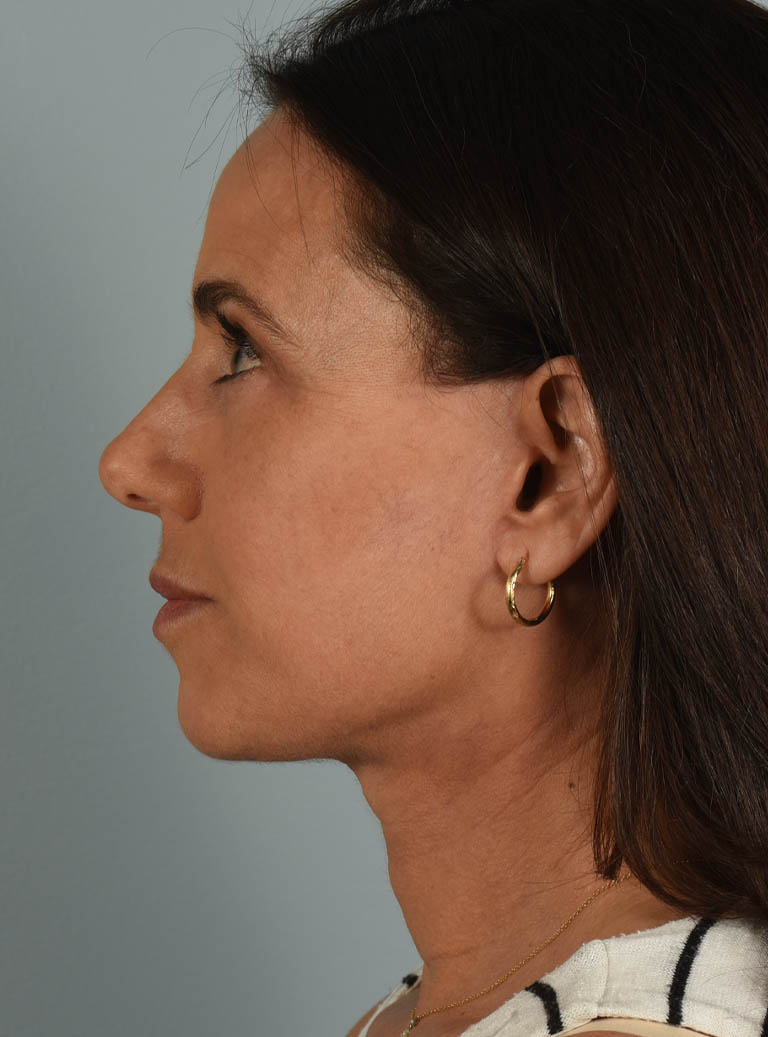 Facelift case #11574