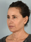 Facelift case #11574