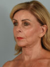 Facelift case #11393