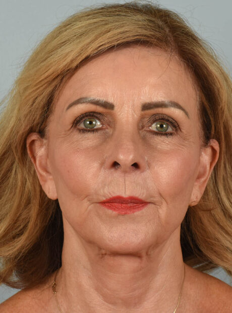 Facelift case #11393