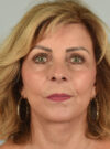 Facelift case #11393