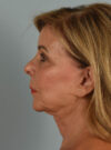 Facelift case #11393