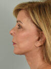 Facelift case #11393