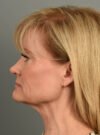Facelift case #11928