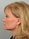 Facelift case #11928