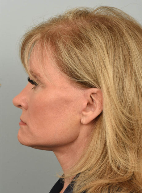 Facelift case #11928