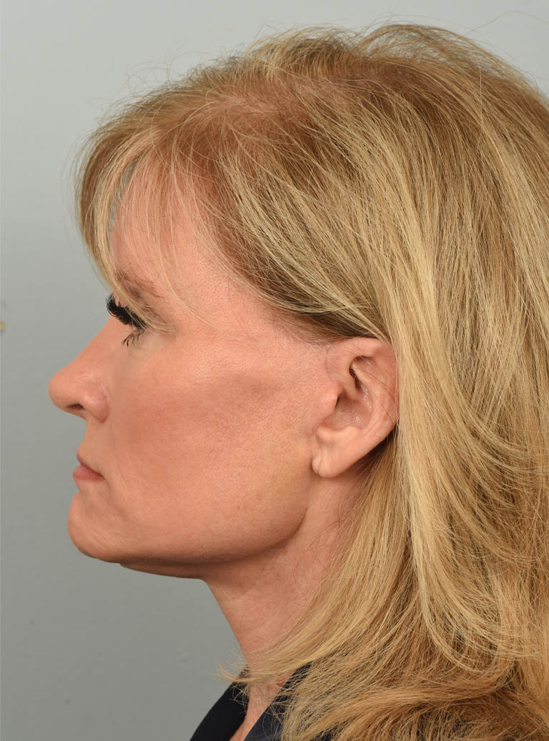 Facelift case #11928
