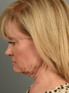 Facelift case #11928