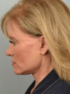 Facelift case #11928