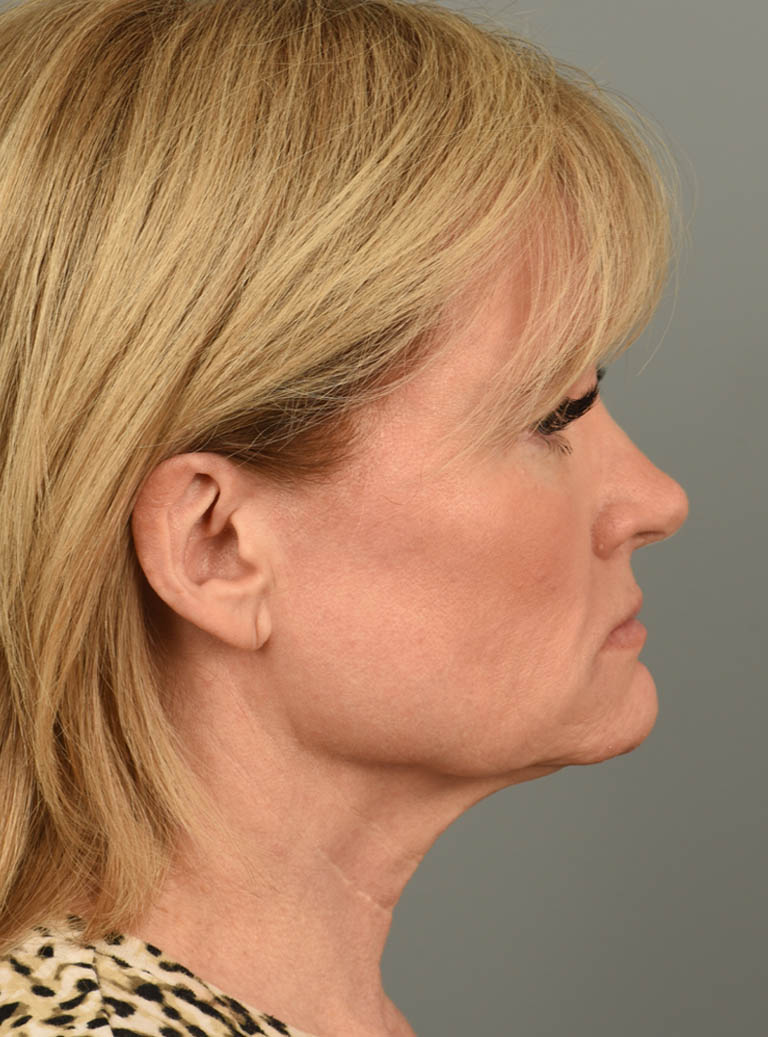 Facelift case #11928