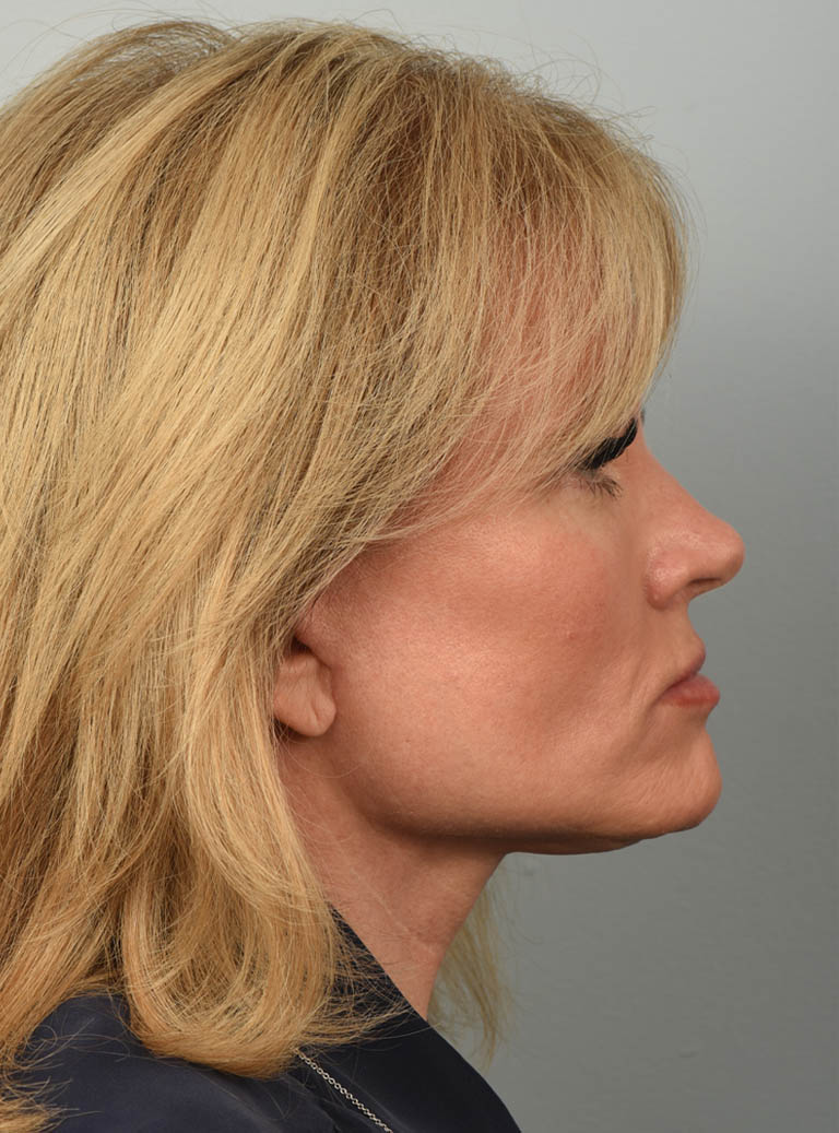 Facelift case #11928