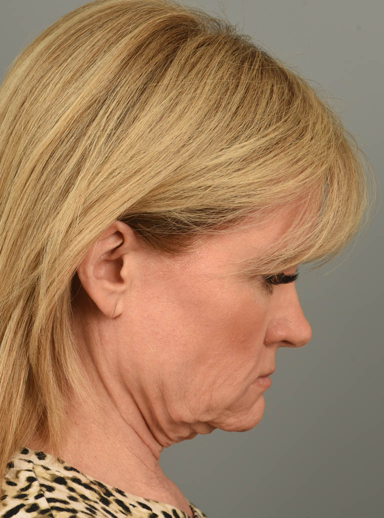 Facelift case #11928